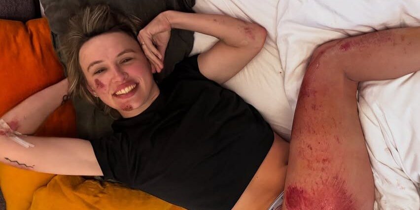 Auch… Kasia Niewiadoma deelt foto van enorme schaafwond na val in Strade Bianche